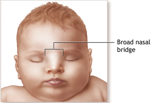 Waadenburg's syndrome