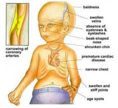 Werner syndrome