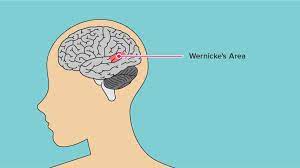 Wernicke encophalopathy