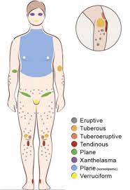 Xanthomatosis