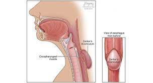 Zenker diverticulum