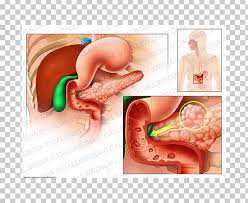 Zollinger ellison syndrome