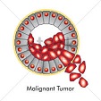 Cancer-malignant mesothelioma