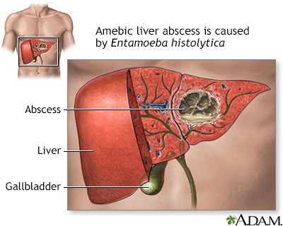 Amoeba Hepar abcess RF