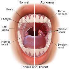 Angina quinsy RF