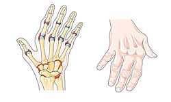 Arthritis Rheumatoid RF