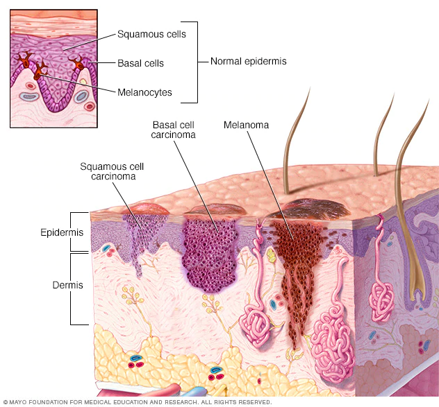 Cancer carcinoma basal cell skin RF