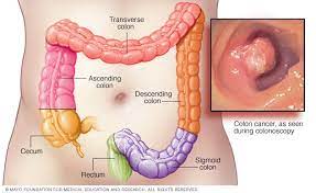 Cancer carcinoma colon RF