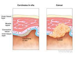 Cancer carcinoma general RF