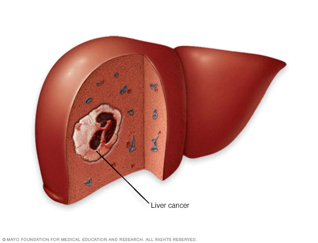 Cancer carcinoma liver RF