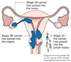 Cancer carcinoma uterine fermentative RF