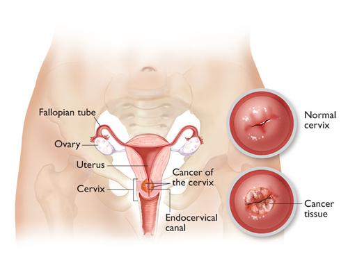 Cancer cervical RF