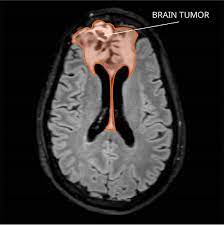 Cancer droglioma RF