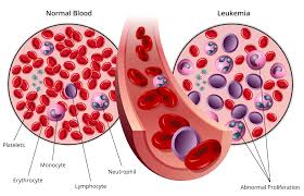 Cancer leukimia lymphatic RF