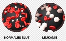 Cancer leukimia T Cell RF