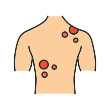 Cancer melanoma 1 RF