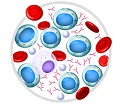 Cancer multiple myeloma RF