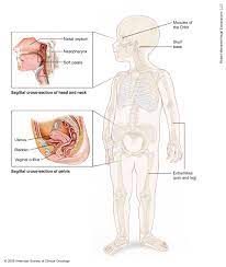 Cancer rhabdomyosarcoma embryonal RF