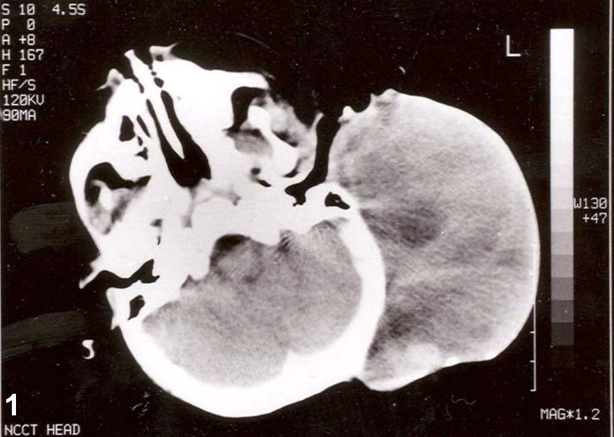 Cancer rhadomysarcoma RF