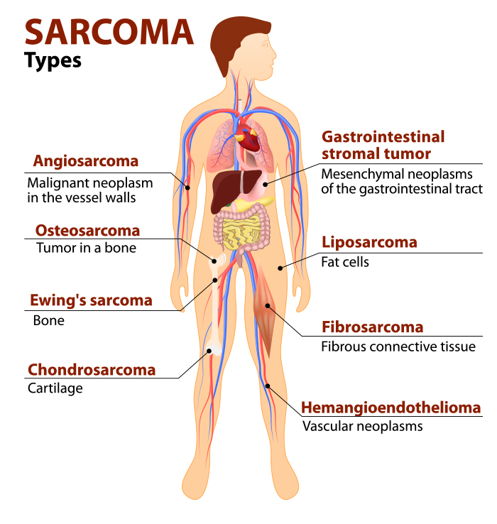 Cancer fibrosarcoma RF