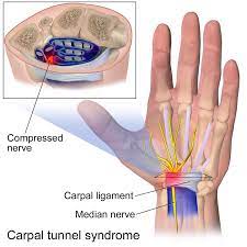 carpal tunel RF