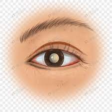 Cataract brunescent RF