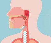 Cancer-oropharyngeal