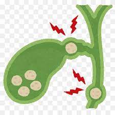 Cholecystitis acute RF