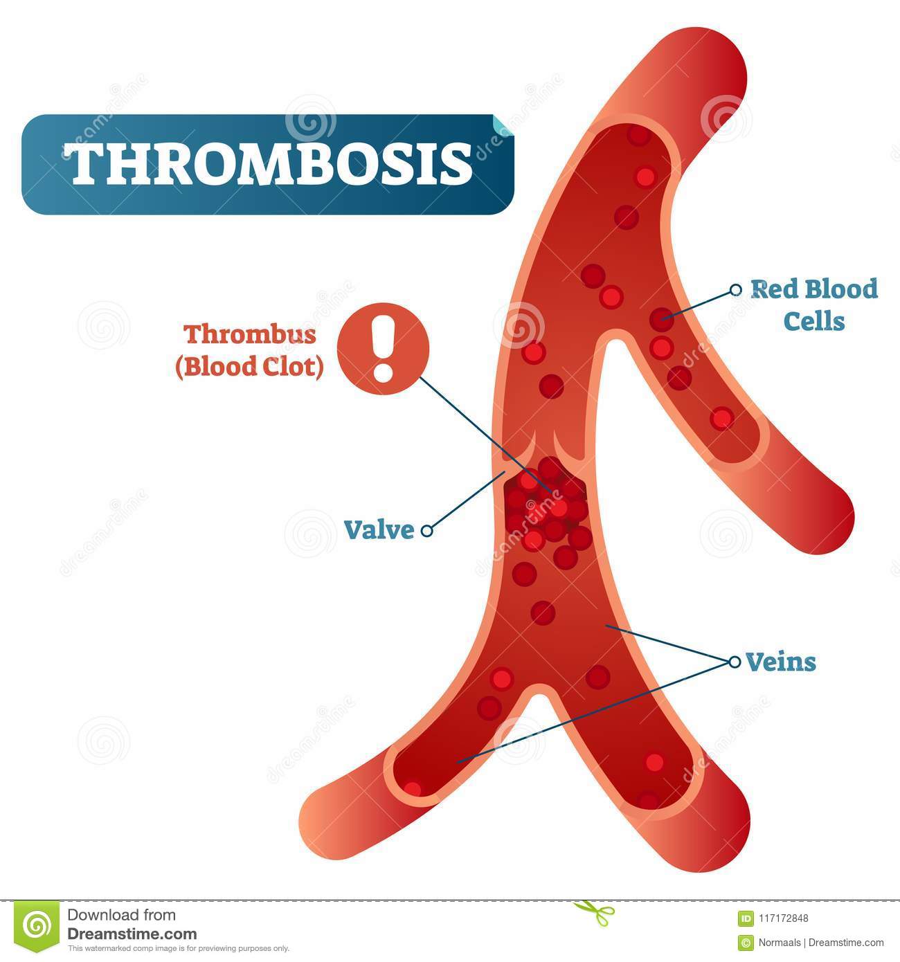 Circulatory stasis RF