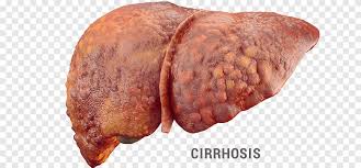 Cirrhosis hepatitis RF