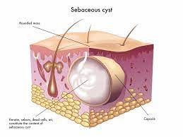 Cyst sebaceous RF