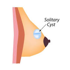 Cyst solitary RF