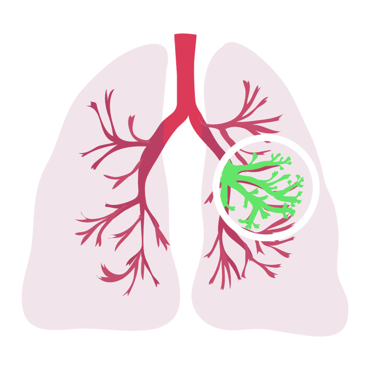 Cystic fibrosis RF