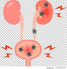 Cysto Pyelonephiritis RF