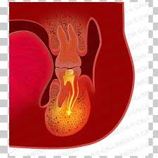 Dental infection 3 RF