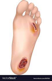 Diabetic toe ulcer RF