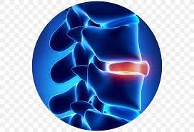 Disc herniated / Saraf Terjepit RF