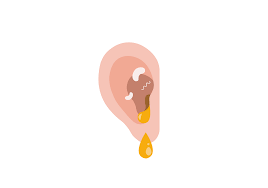 Ear fungus RF