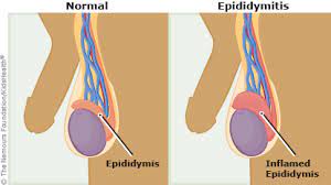 Epididymitis RF