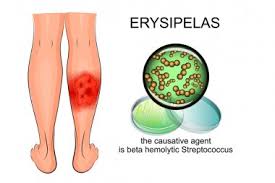 Erysipelas RF