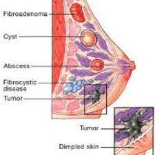Fibroadenoma mamae RF