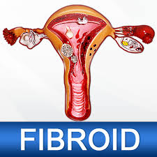 Fibroids RF