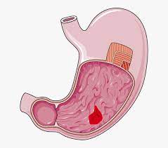 Fistulla ulcer RF