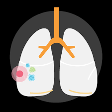 Carcinoma, Small cell