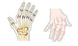 Cartilage diseases