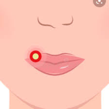 Cheilitis