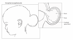 Encephalocele
