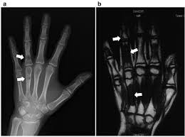 Enchondromatosis