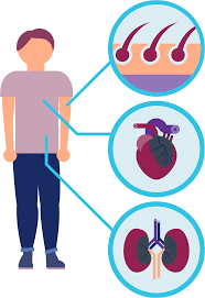 Fabry disease