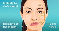 Facial nerve disease